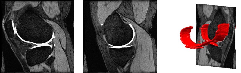 Cartilage segmentation